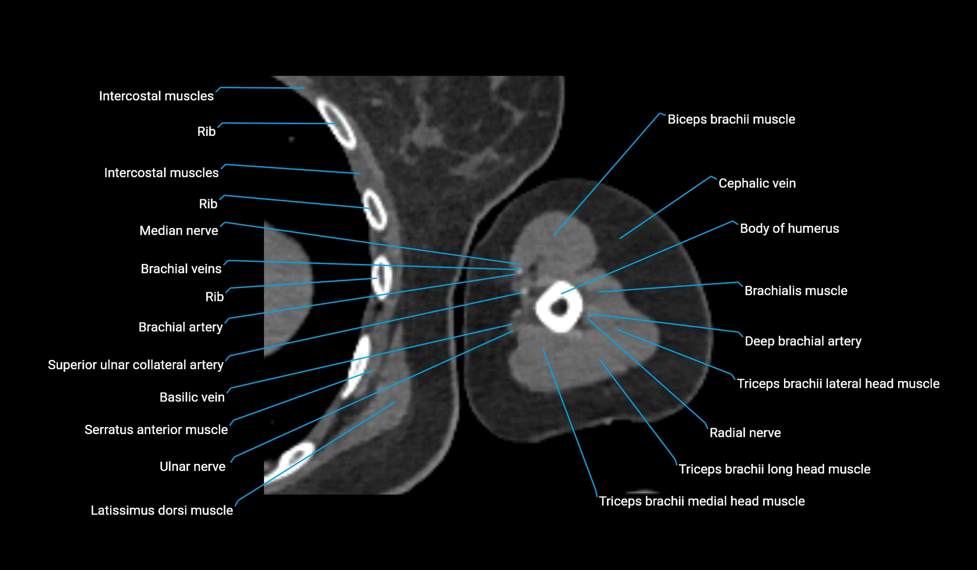 CT upper arm axial  cross sectional anatomy labelled radiology image -00252.webp